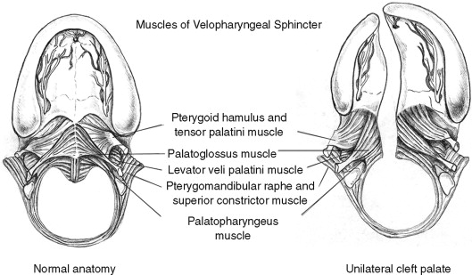 cleft palate anatomy