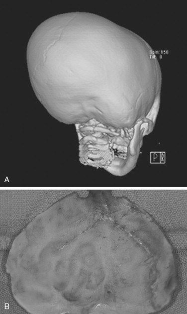 Craniofacial Dysostosis Syndromes | Pocket Dentistry