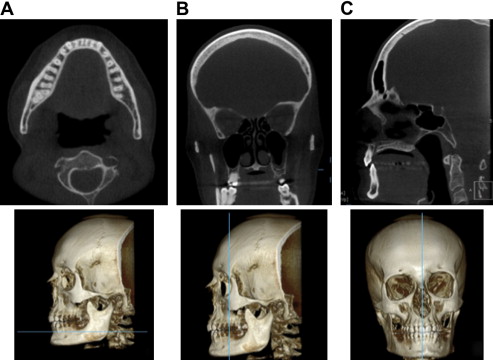Cone Beam Tomographic Imaging Anatomy Of The Maxillofacial Region 