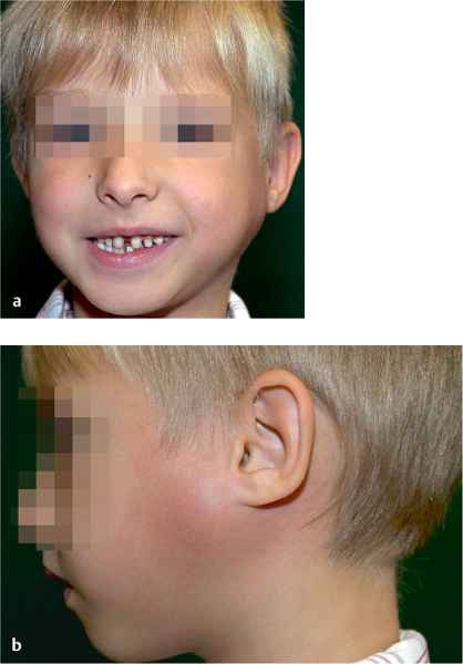 submandibular gland swelling in children