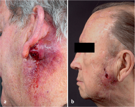 Tumor neuroendocrino benigno