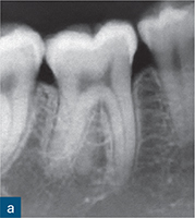 acute apical periodontitis