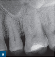 acute apical periodontitis