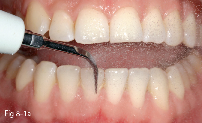 Teeth Staining Chart