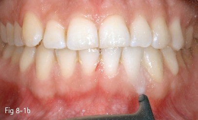 Tooth Discoloration Pocket Dentistry