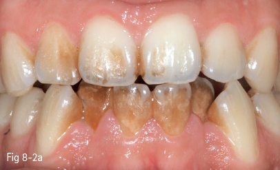 Teeth Staining Chart