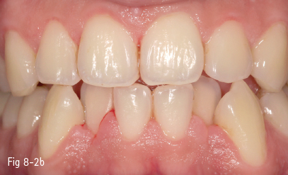 Tooth Discoloration Pocket Dentistry