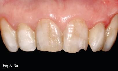 Tooth Discoloration Pocket Dentistry