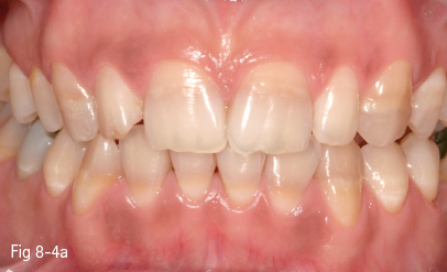 Tooth Discoloration Pocket Dentistry