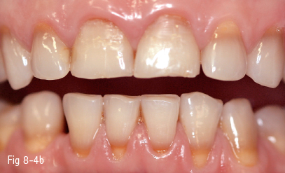 Tooth Discoloration Pocket Dentistry