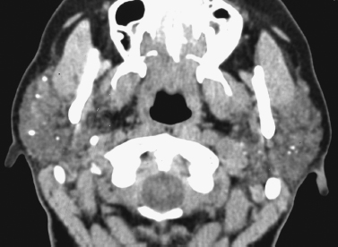 Imaging of the Salivary Glands | Pocket Dentistry