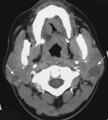 submandibular gland cyst