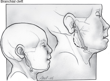 submandibular gland swelling in children