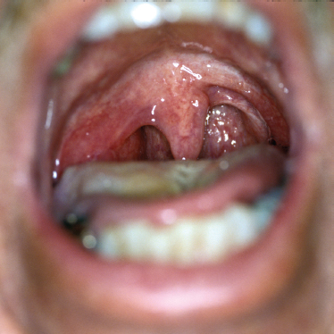 Marginal Mandibular Nerve Weakness (Ramus Mandibularis) - Level I Neck  Dissection (extended) recurrent pleomorphic adenoma - Clinical case example