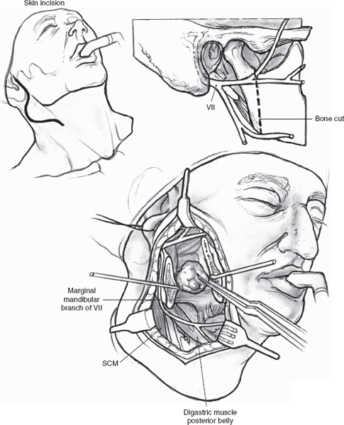 Marginal Mandibular Nerve Weakness (Ramus Mandibularis) - Level I Neck  Dissection (extended) recurrent pleomorphic adenoma - Clinical case example