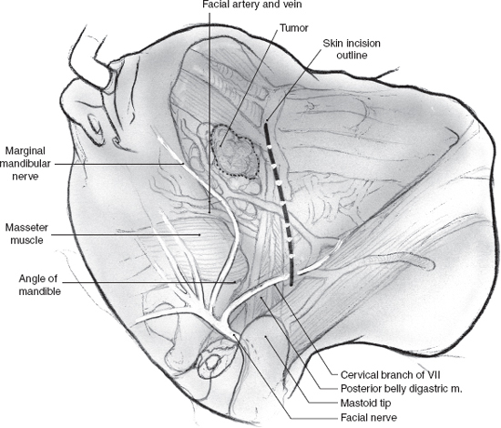 Marginal Mandibular Nerve Weakness (Ramus Mandibularis) - Level I Neck  Dissection (extended) recurrent pleomorphic adenoma - Clinical case example