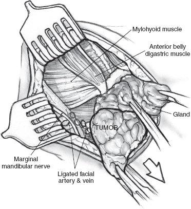 Marginal Mandibular Nerve Weakness (Ramus Mandibularis) - Level I Neck  Dissection (extended) recurrent pleomorphic adenoma - Clinical case example