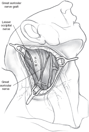 Mobilization technique with fascia lata as interposition graft. (A)