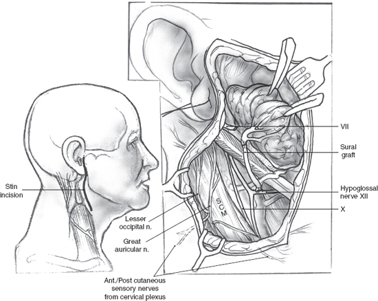 Facial Paralysis Rehabilitation