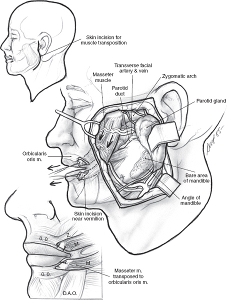 Facial Paralysis Rehabilitation Pocket Dentistry