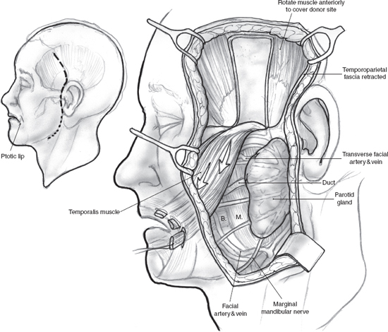 Facial Paralysis Rehabilitation