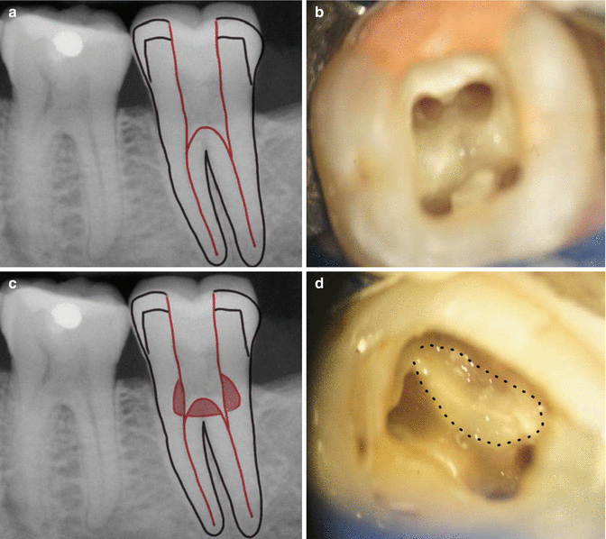Iatrogenic Perforations Pocket Dentistry