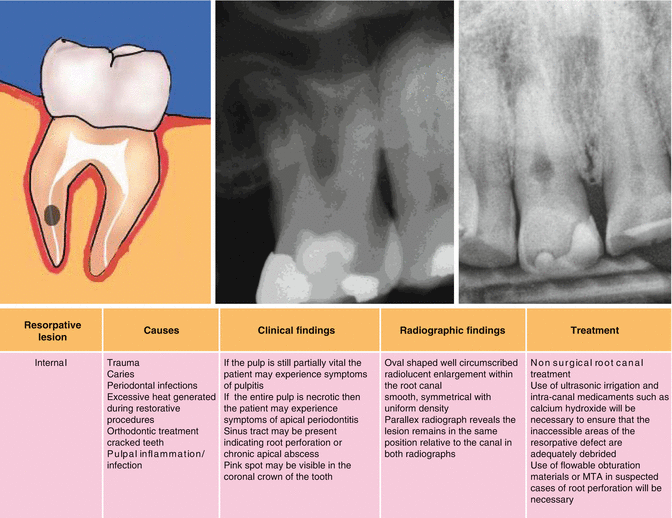 external resorption of tooth