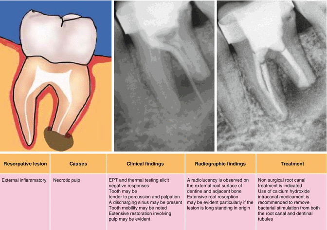 Resorption cavity rings and localized vascular changes within the