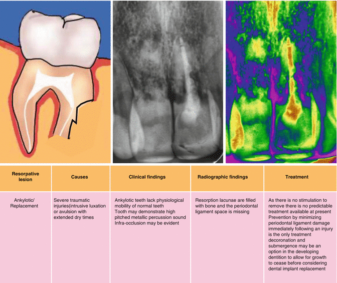 Root Resorption Pocket Dentistry