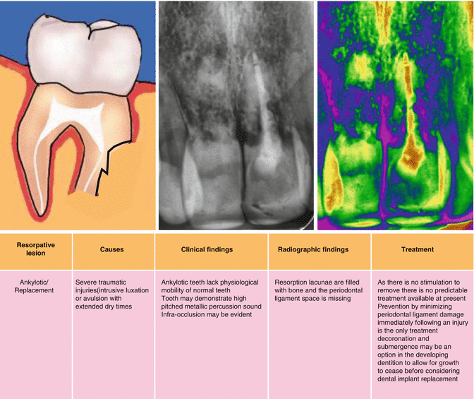 External Resorption Vs Internal Resorption