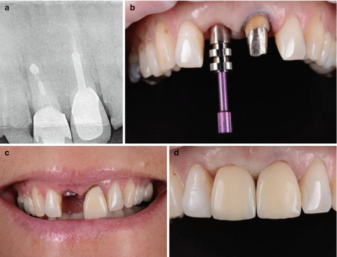 Esthetic Re Treatment Of Anterior Teeth Restored Foll - vrogue.co