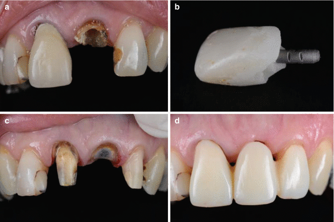 Restoration of the Endodontically Treated Tooth Pocket Dentistry