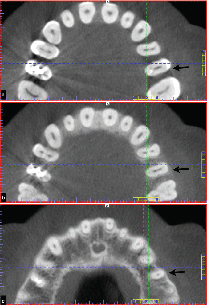 Access Preparation Pocket Dentistry