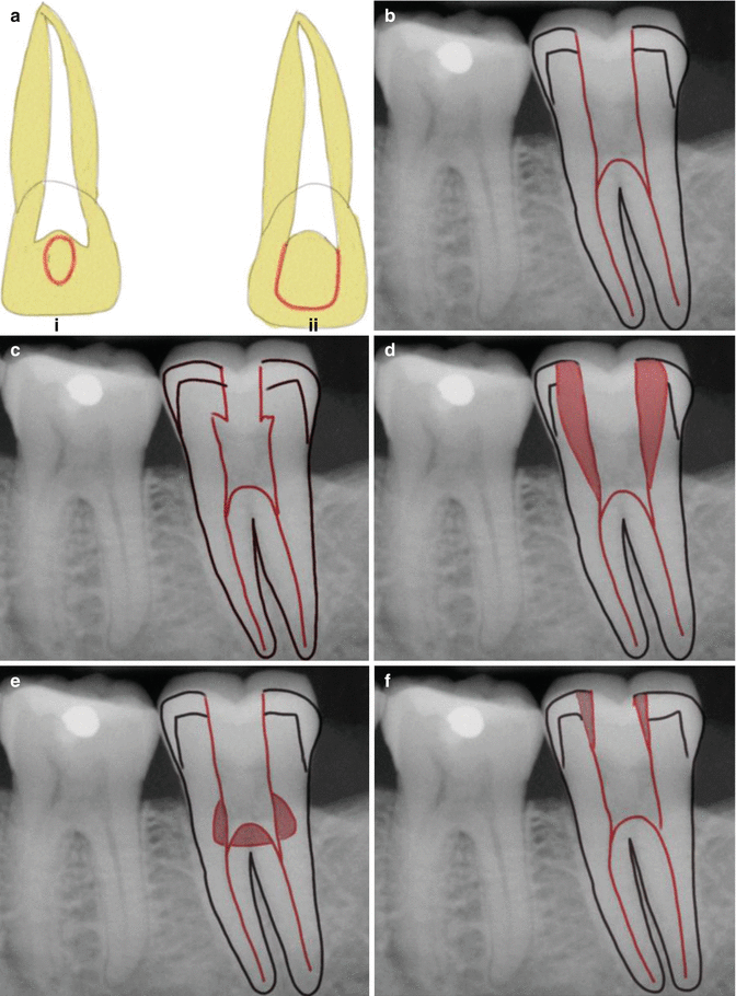 Access Preparation Pocket Dentistry