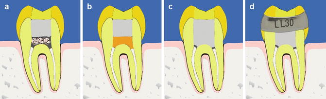 Temporary filling placement 