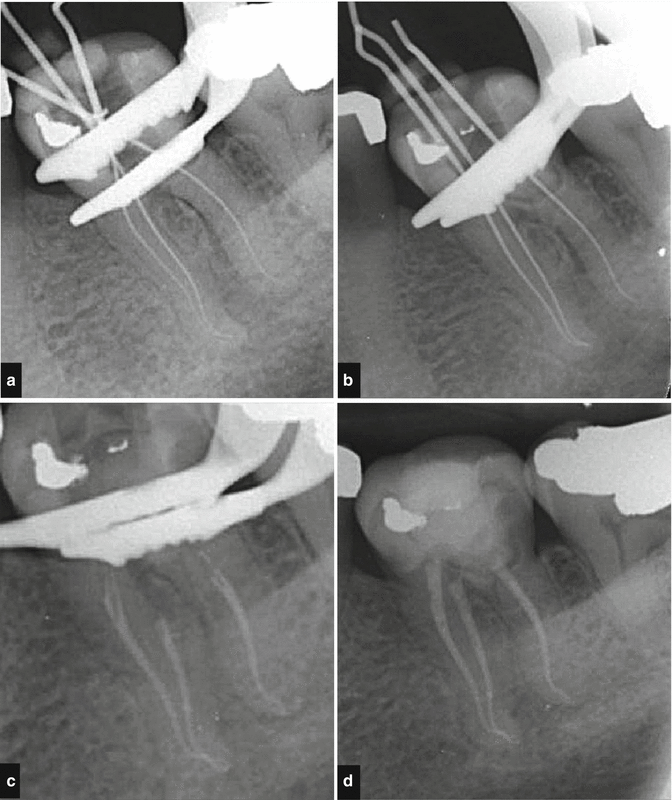 Non-surgical Root Canal Treatment | Pocket Dentistry