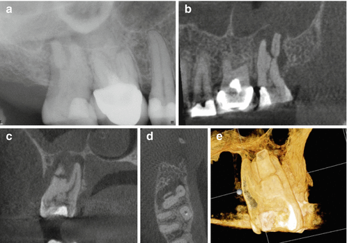 A) Preoperative periapical radiograph of tooth #21. Note the