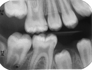 The Chemistry of Caries: Remineralization and Demineralization Events ...