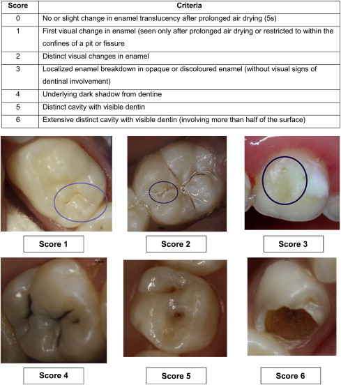 Detection Activity Assessment and Diagnosis of Dental Caries Lesions ...