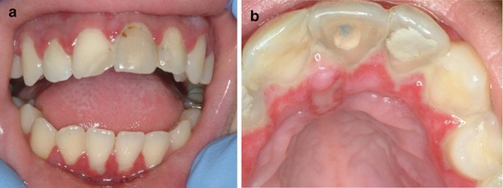 herpetic gingivostomatitis gums