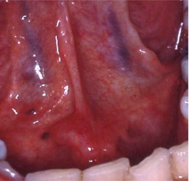 PPT - Differential Diagnosis of Oral and Maxillofacial Diseases for the  Non-Dental Provider PowerPoint Presentation - ID:2035025