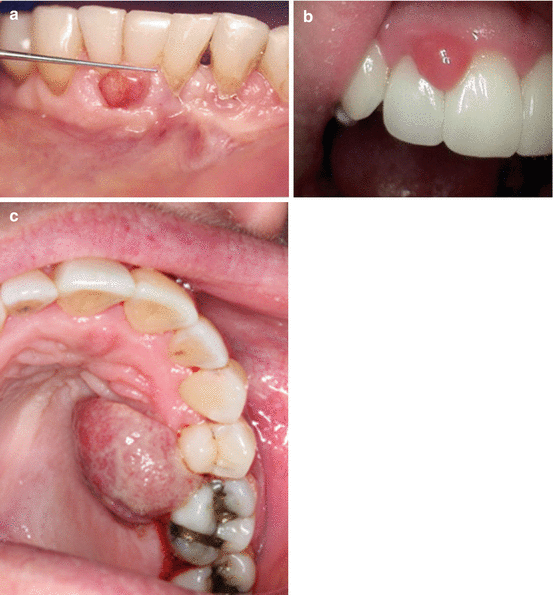 Common Lesions in Oral Pathology for the General Dentist Pocket Dentistry