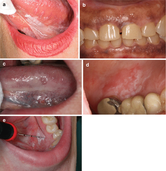 Oral Lesions Under Tongue