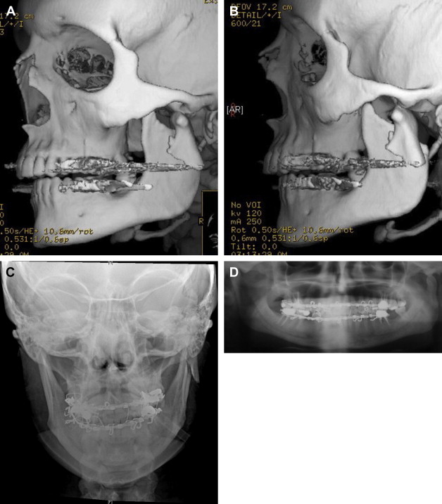 mandibular condyle