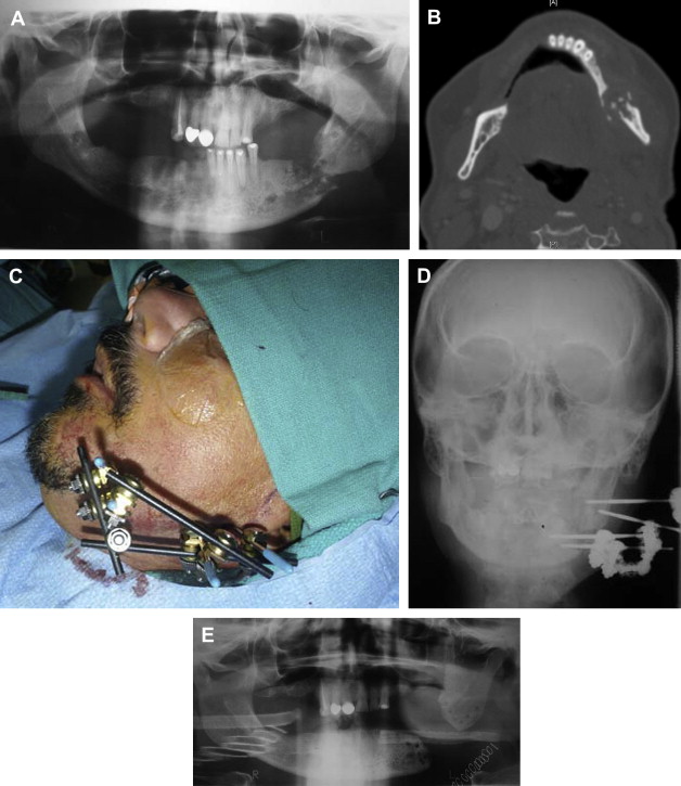 External Fixation For Mandible Fractures Pocket Dentistry 0919