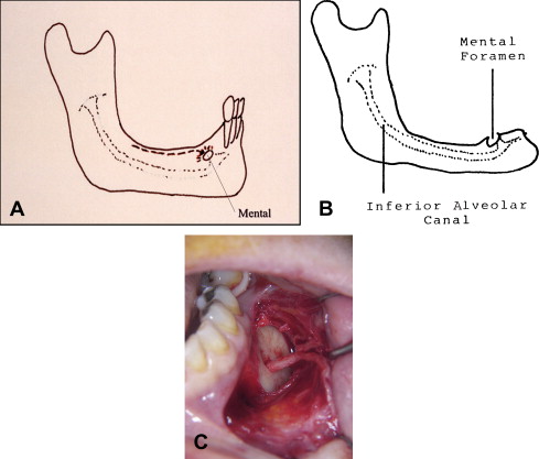 Dental implants: Mandibular neurovascular considerations 