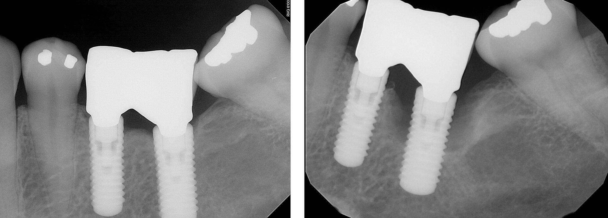 Radiograph of dental implant displaying implanted teeth prosthesis.