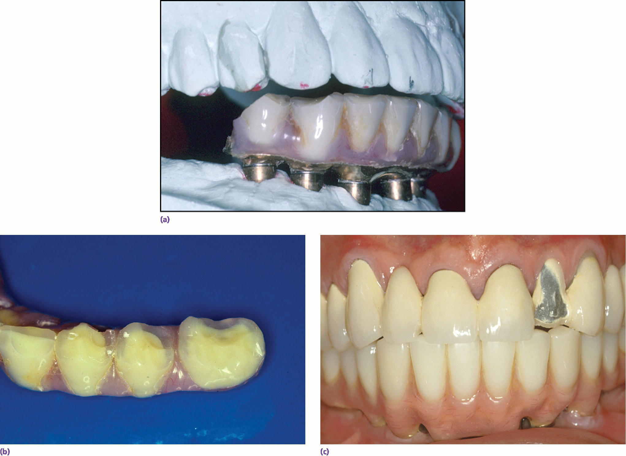 Photo of an implanted denture displaying 1 fractured tooth.