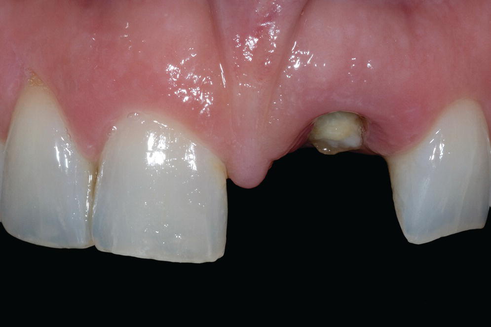 Photo of gum and upper central maxillary incisors and lateral maxillary incisors with left central maxillary incisor missing.