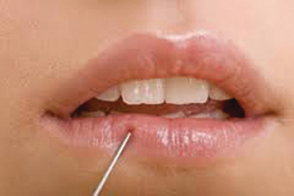 Assessing anesthesia displaying photo of a mouth where the lower lip is stricken by a small metal stick to depict noxious stimuli.